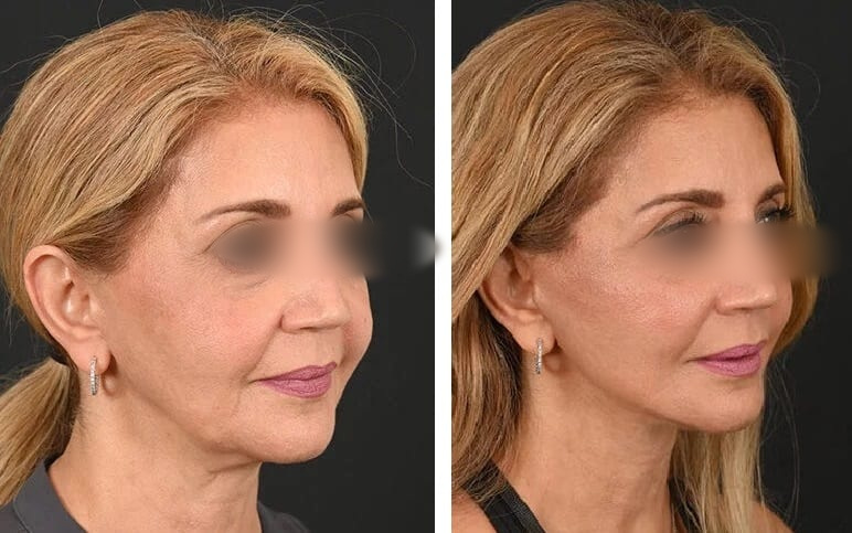 Lifting Facial y Cuello caso 2 — antes y después